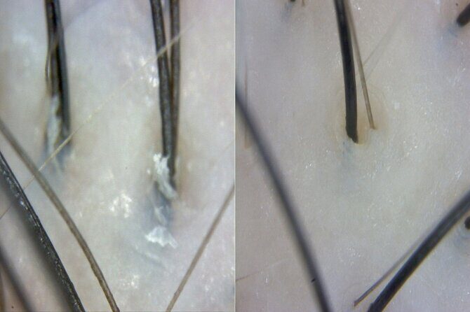 15 Step Stem Cell Scalp Treatment in Seoul - Key Points