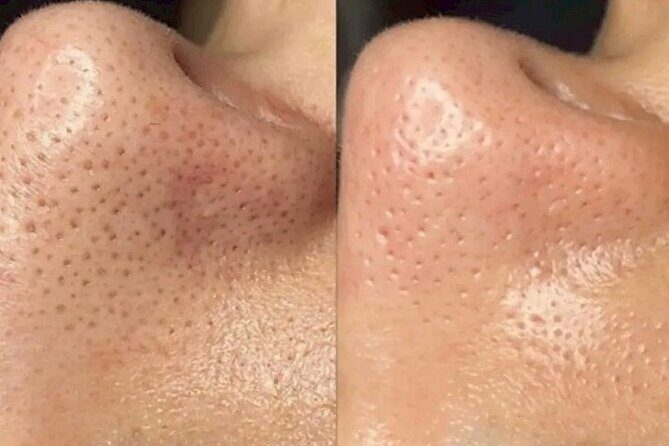 HydraFacial and Dry Head Spa Treatment in Shibuya - Final Thoughts