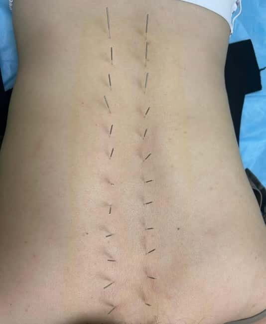 Shanghai: Chinese Medicine Acupuncture and Cupping Session - Key Points