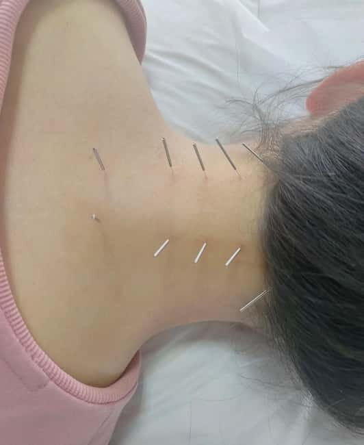 Shanghai: Chinese Medicine Acupuncture and Cupping Session - The Sum Up
