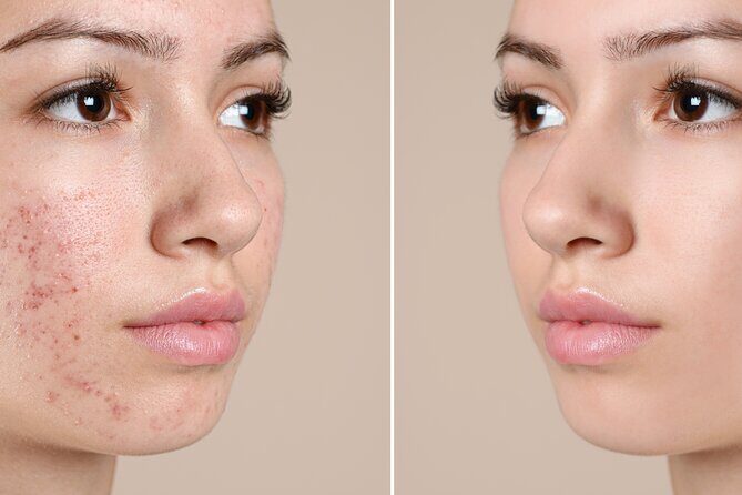 Skin Glo Package w/microderm/LED- For 2 with Appetizers and Wine - FAQ